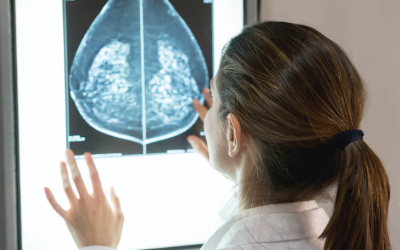 L’IA peut prédire l’efficacité de la chimiothérapie du cancer du sein