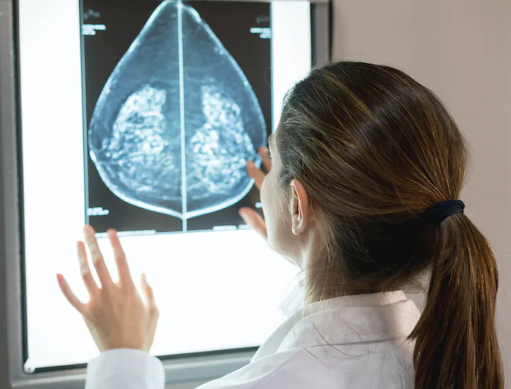 L’IA peut prédire l’efficacité de la chimiothérapie du cancer du sein